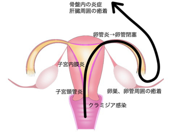 クラミジア感染経路