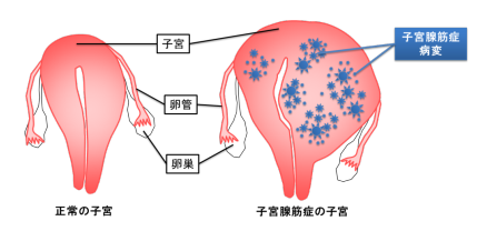 子宮腺筋症